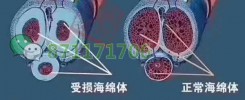 阴茎海绵体损伤怎么办
