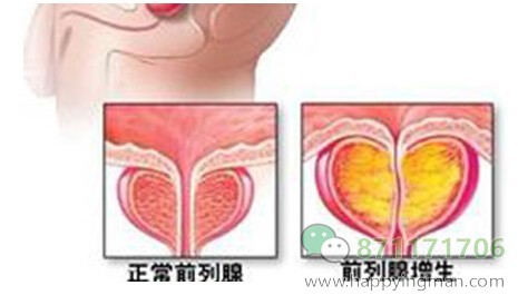 前列腺增生